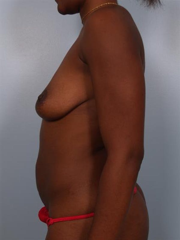 Breast Augmentation Before & After Gallery - Patient 1310903 - Image 5