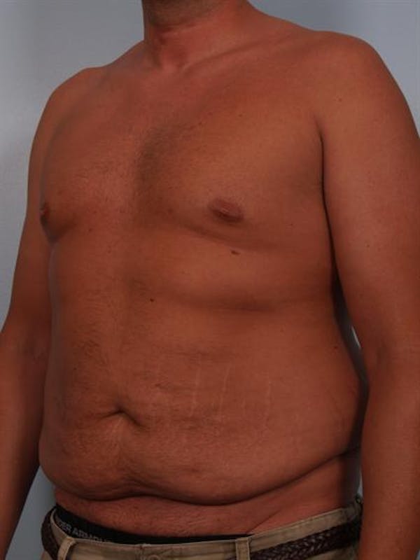 Male Tummy Tuck Gallery - Patient 1310906 - Image 3