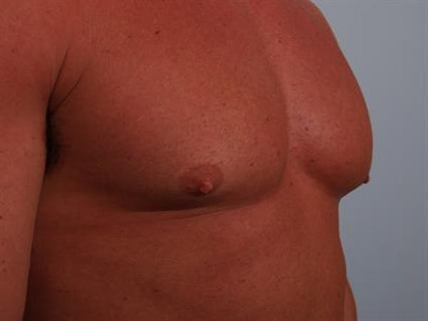Male Breast/Areola Reduction Before & After Gallery - Patient 1310907 - Image 5