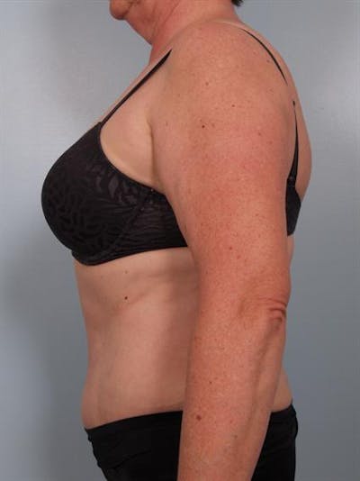 Tummy Tuck Before & After Gallery - Patient 1310902 - Image 6