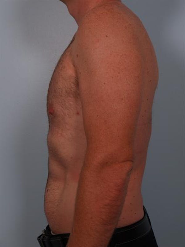 Male Liposuction Before & After Gallery - Patient 1310910 - Image 2