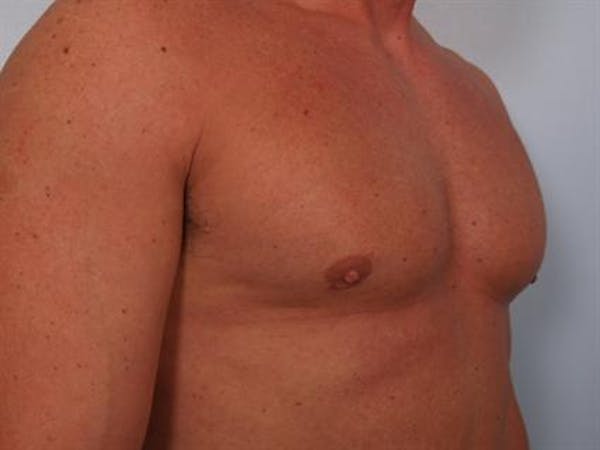 Male Breast/Areola Reduction Before & After Gallery - Patient 1310907 - Image 6