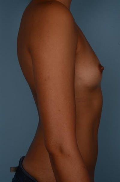 Power Assisted Liposuction Before & After Gallery - Patient 1310908 - Image 1