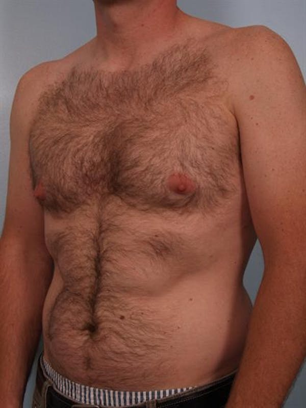 Male Liposuction Before & After Gallery - Patient 1310910 - Image 3