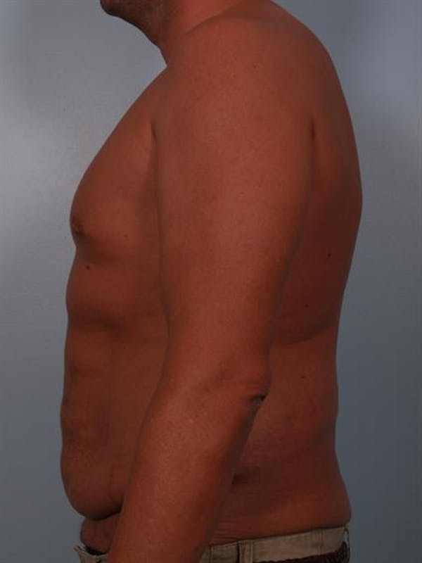 Male Tummy Tuck Before & After Gallery - Patient 1310906 - Image 5