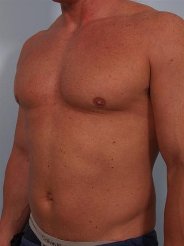 Male Breast/Areola Reduction Before & After Gallery - Patient 1310907 - Image 8