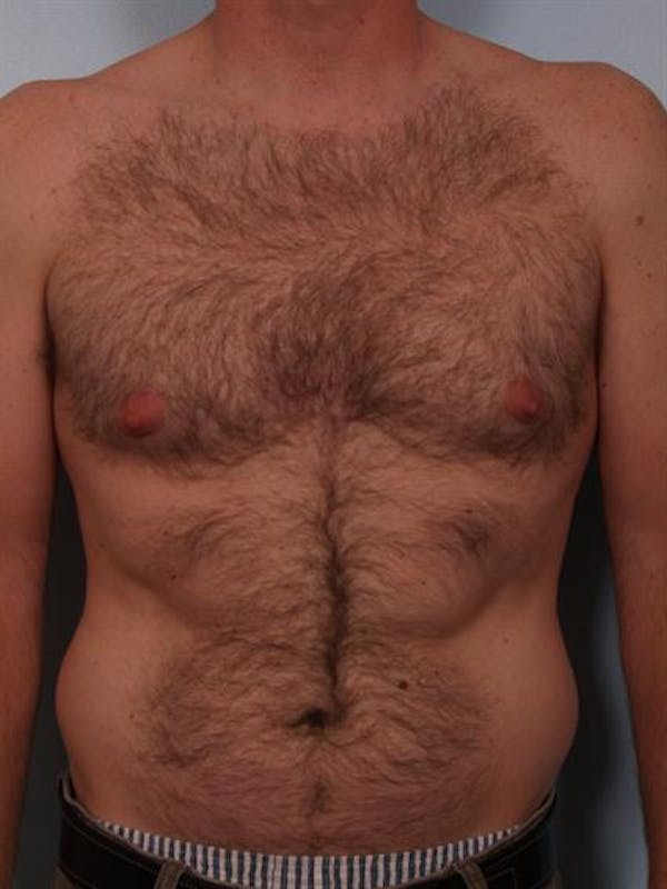 Male Liposuction Before & After Gallery - Patient 1310910 - Image 5