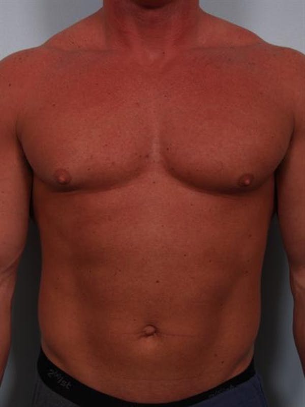 Male Breast/Areola Reduction Before & After Gallery - Patient 1310907 - Image 9
