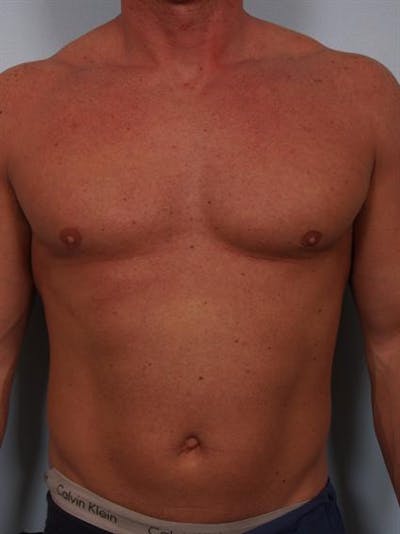 Male Breast/Areola Reduction Before & After Gallery - Patient 1310907 - Image 10