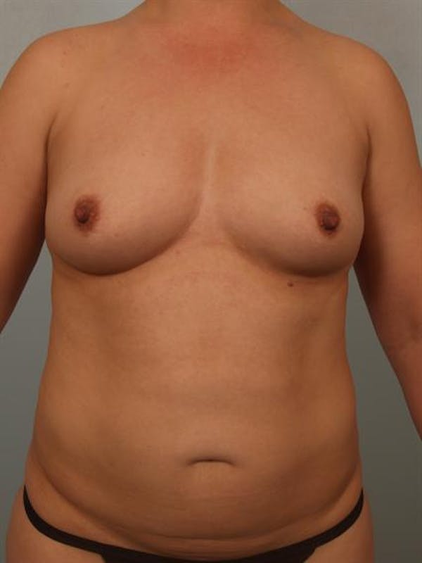 Breast Augmentation Gallery - Patient 1310911 - Image 1