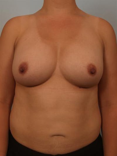 Breast Augmentation Before & After Gallery - Patient 1310911 - Image 2