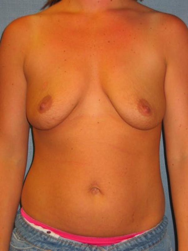 Breast Lift Gallery - Patient 1310914 - Image 1