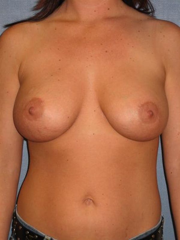 Breast Lift Gallery - Patient 1310914 - Image 2