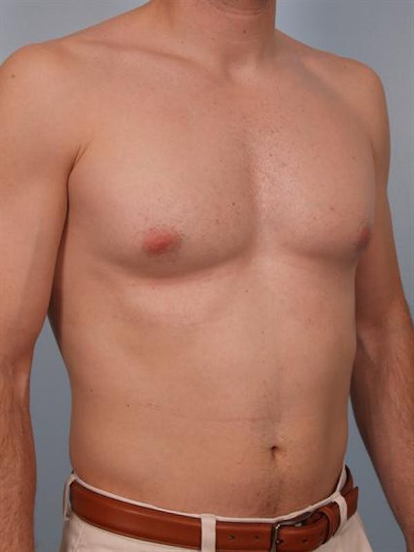 Male Breast/Areola Reduction Before & After Gallery - Patient 1310912 - Image 3