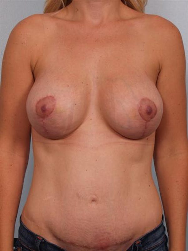 Tummy Tuck Before & After Gallery - Patient 1310916 - Image 2