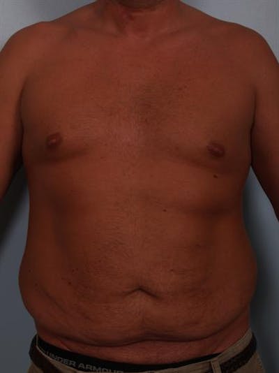 Male Liposuction Before & After Gallery - Patient 1310917 - Image 1