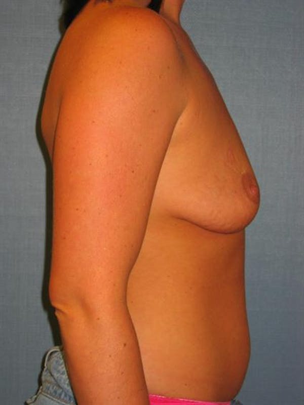 Breast Lift Before & After Gallery - Patient 1310914 - Image 5