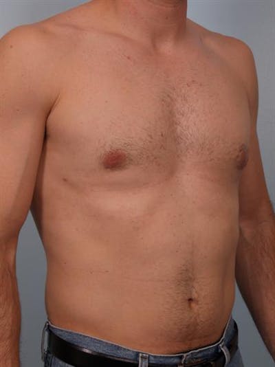 Male Breast/Areola Reduction Gallery - Patient 1310912 - Image 4