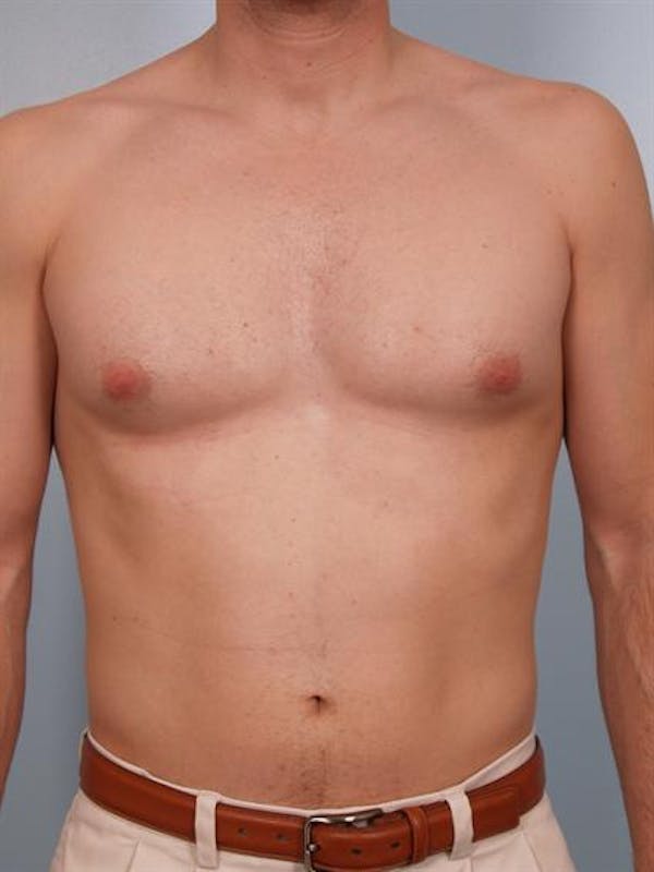 Male Breast/Areola Reduction Before & After Gallery - Patient 1310912 - Image 5
