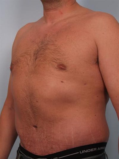 Male Liposuction Before & After Gallery - Patient 1310917 - Image 4