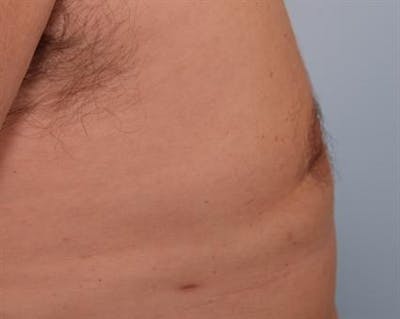 Power Assisted Liposuction Before & After Gallery - Patient 1310915 - Image 6