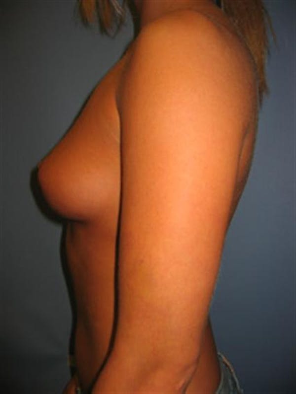 Breast Augmentation Before & After Gallery - Patient 1310922 - Image 1