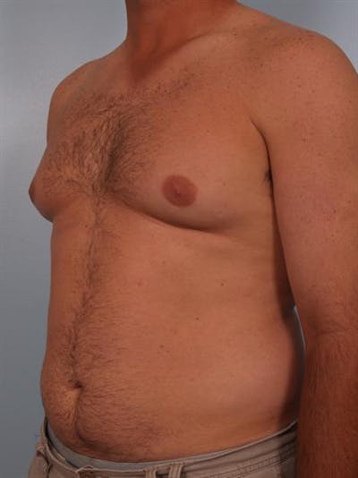 Male Breast/Areola Reduction Before & After Gallery - Patient 1310919 - Image 1