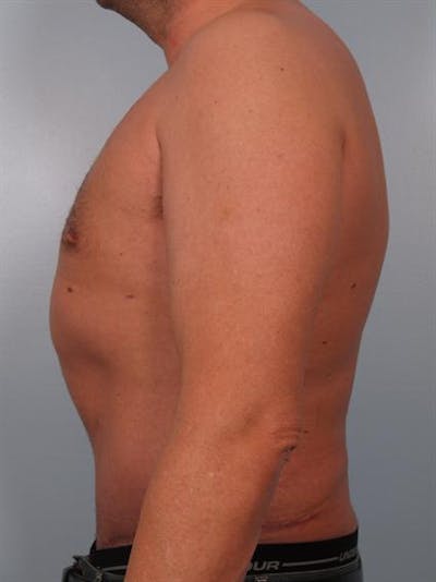Male Liposuction Before & After Gallery - Patient 1310917 - Image 6