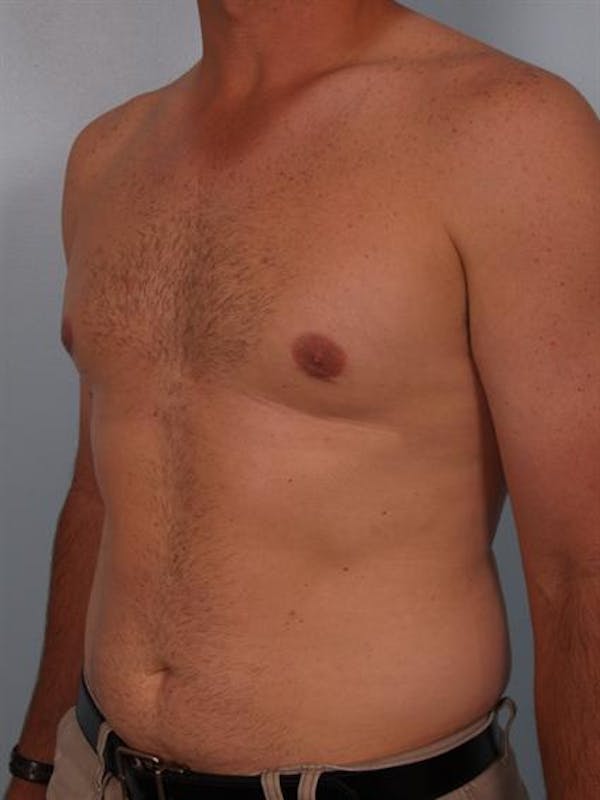 Male Breast/Areola Reduction Before & After Gallery - Patient 1310919 - Image 2