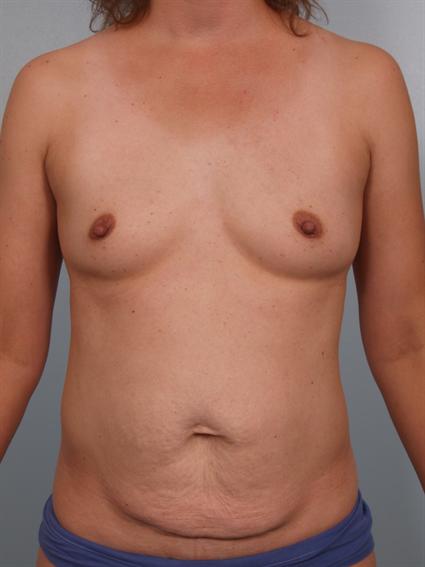 Image3 - Before image of Tummy Tuck in Beverly Hills by Dr. Cohen.