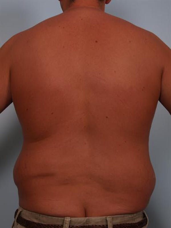 Male Liposuction Before & After Gallery - Patient 1310917 - Image 7