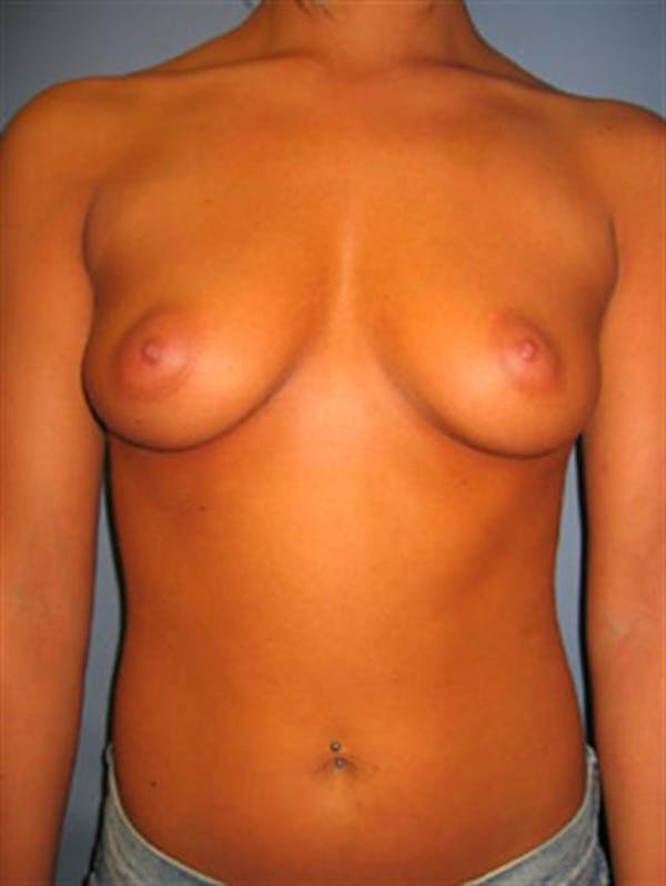 Breast Augmentation Before & After Gallery - Patient 1310922 - Image 3