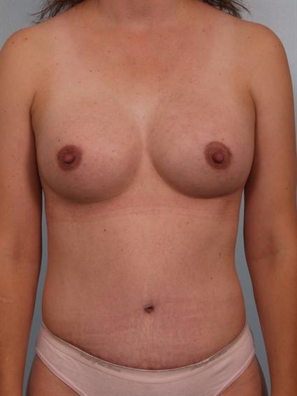 Image3 - After image of Tummy Tuck in Beverly Hills by Dr. Cohen.