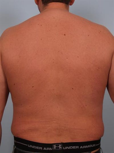 Male Liposuction Before & After Gallery - Patient 1310917 - Image 8