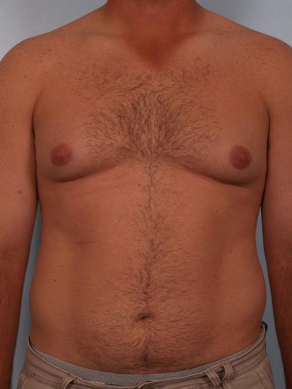 Male Breast/Areola Reduction Before & After Gallery - Patient 1310919 - Image 3
