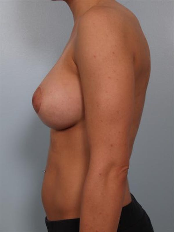Breast Lift Gallery - Patient 1310924 - Image 4