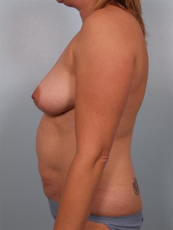Mommy Makeover Before & After Gallery - Patient 1310921 - Image 3
