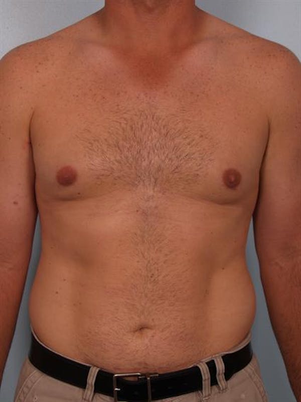 Male Breast/Areola Reduction Gallery - Patient 1310919 - Image 4