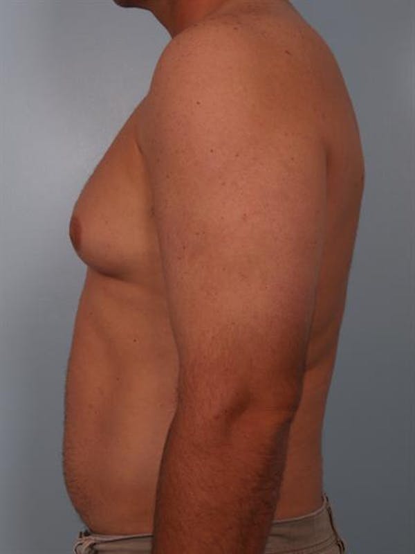 Male Breast/Areola Reduction Before & After Gallery - Patient 1310919 - Image 5