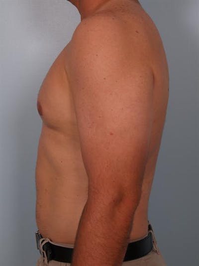 Male Breast/Areola Reduction Before & After Gallery - Patient 1310919 - Image 6