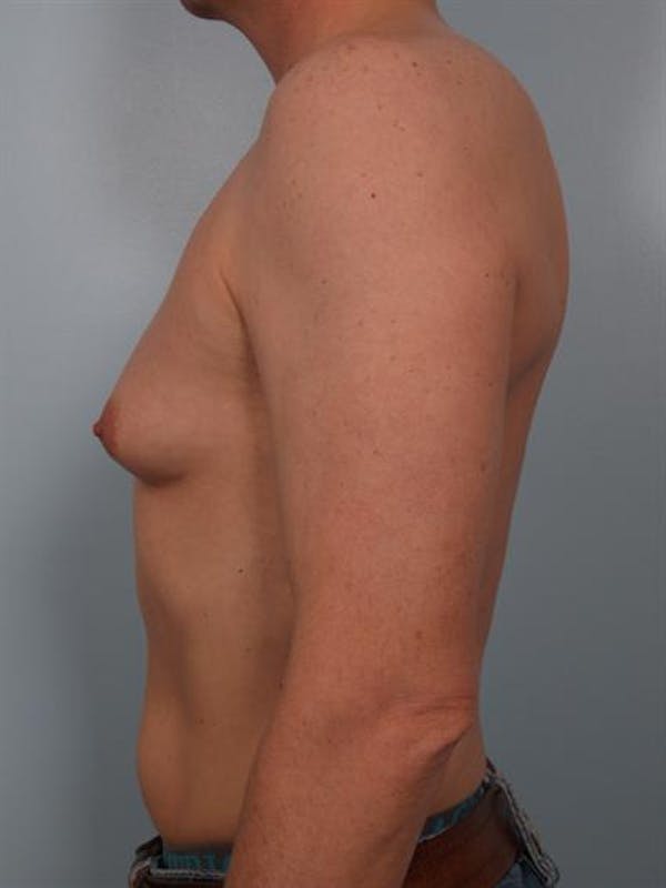 Male Breast/Areola Reduction Before & After Gallery - Patient 1310925 - Image 3