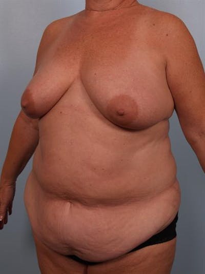 Tummy Tuck Before & After Gallery - Patient 1310926 - Image 1
