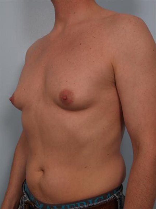 Male Breast/Areola Reduction Before & After Gallery - Patient 1310925 - Image 1