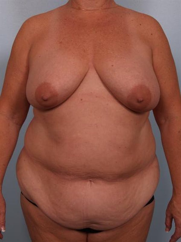 Tummy Tuck Before & After Gallery - Patient 1310926 - Image 3