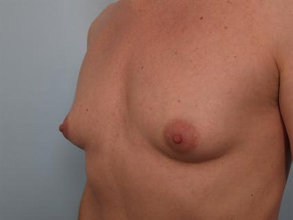 Male Breast/Areola Reduction Gallery - Patient 1310925 - Image 5