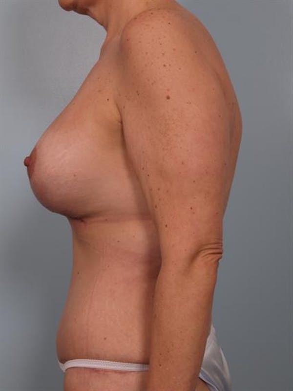 Power Assisted Liposuction Before & After Gallery - Patient 1310927 - Image 4
