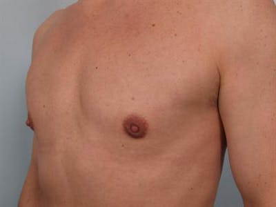 Male Breast/Areola Reduction Before & After Gallery - Patient 1310925 - Image 6