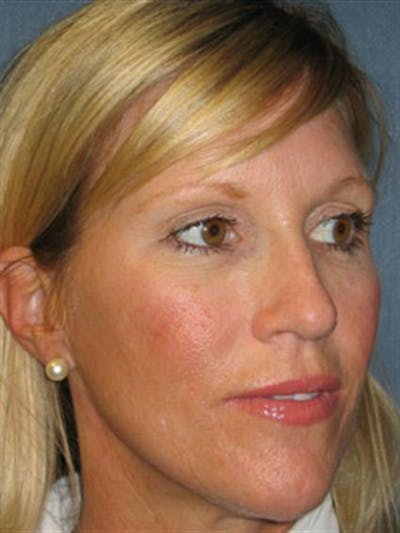 Botox Before & After Gallery - Patient 1310931 - Image 2