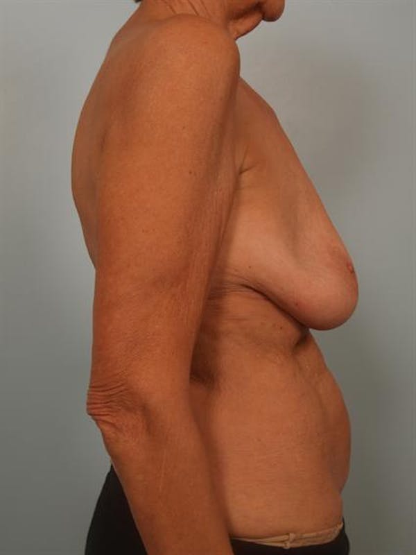Breast Lift Before & After Gallery - Patient 1310930 - Image 5