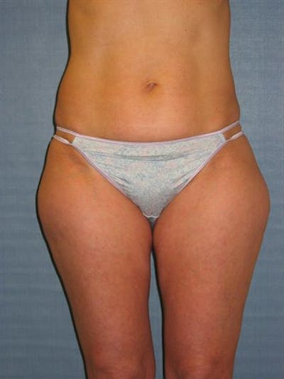 Power Assisted Liposuction Before & After Gallery - Patient 1310933 - Image 1